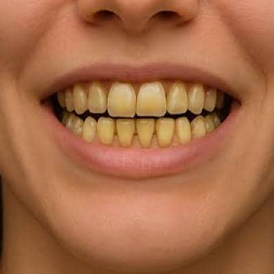 علت زرد شدن دندان؛ مسواک می‌زنید اما دندان‌هایتان زرد است؟