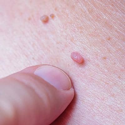 تقویت سیستم ایمنی بدن برای درمان زگیل تناسلی؛ از تغذیه تا خواب