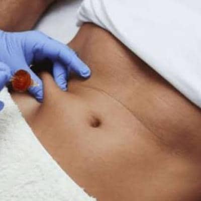 بوتاکس معده چیست و چگونه باعث لاغری می‌شود؟