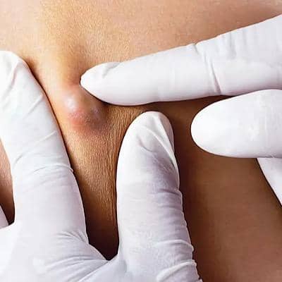 مهم‌ترین علائم کیست مویی و درمان این بیماری شایع
