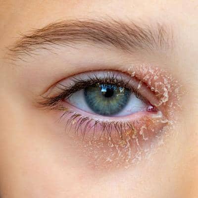 بلفاریت چشم و همه چیز درباره علائم و علت آن