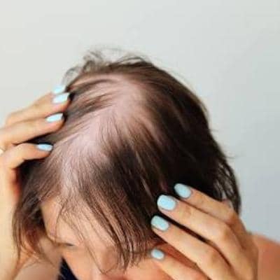 مهم‌ترین تاثیر کبد چرب بر ریزش مو