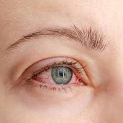 همه چیز درباره خارش چشم و راه‌های پیشگیری و درمان آن