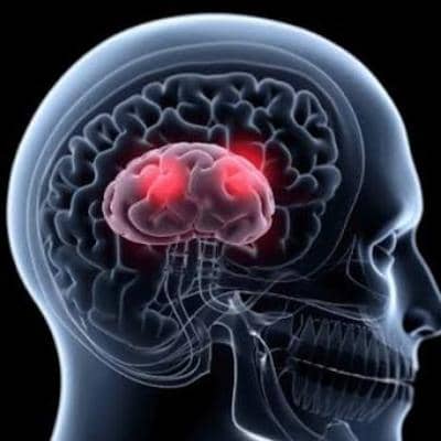 متاستاز مغزی، مهم‌ترین علائم و روش‌های پیشرفته درمان آن