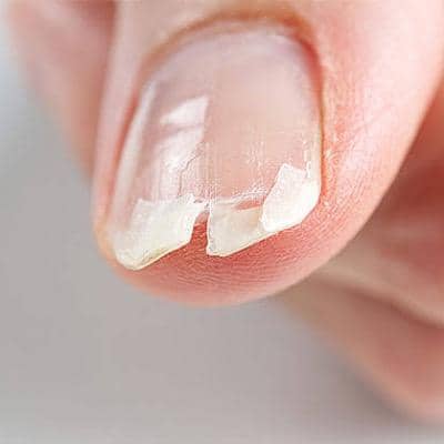 شکنندگی ناخن نشانه کمبود چیست؟