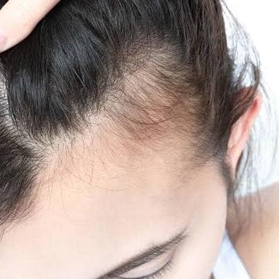 تاثیر هورمون‌ها بر مو: آیا کلید زیبایی در بدن ما نهفته است؟