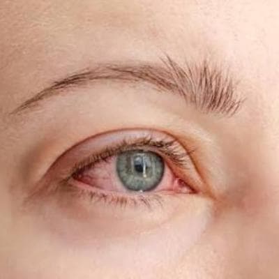 همه چیز درباره خارش چشم و راه‌های پیشگیری و درمان آن