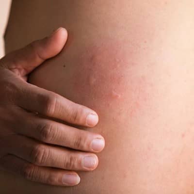 راش پوستی چیست؟ هر آنچه باید از این بیماری پوستی بدانید