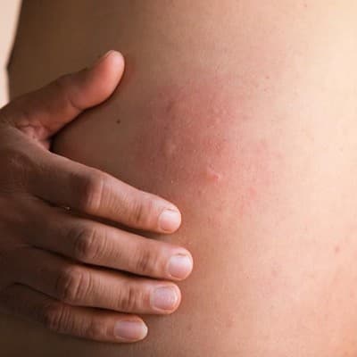راش پوستی چیست؟ هر آنچه باید از این بیماری پوستی بدانید
