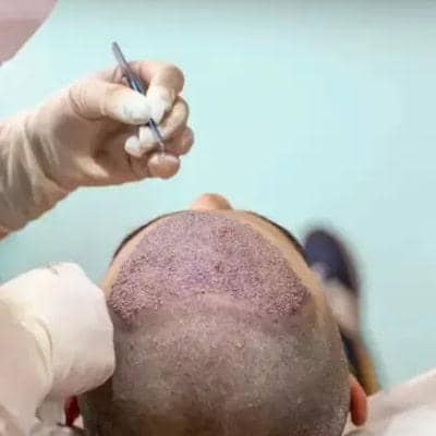 آشنایی با 7 مرحله کاشت مو + مراقبتهای پس از آن