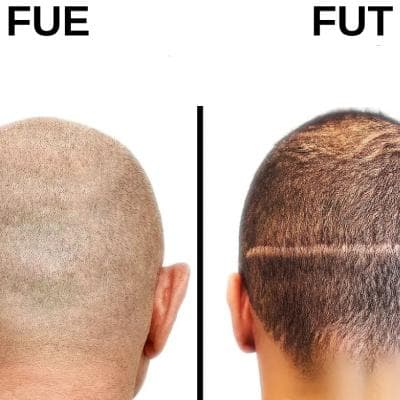 تفاوت بین روشهای FUE و FUT در کاشت مو؛ کدام روش برای شما مناسبتر است؟