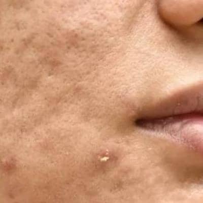 جوش صورت نشانه چیست؟ + مهمترین نکات