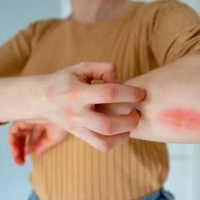 از علائم اولیه تا مهمترین علل آنافیلاکسی
