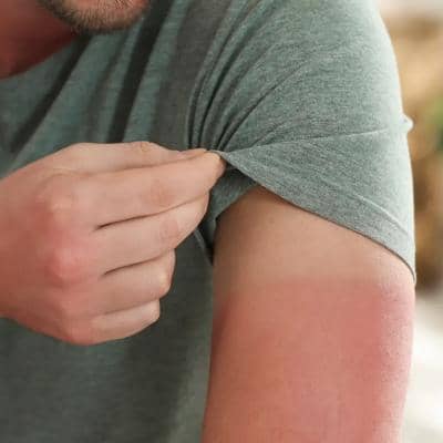 بهترین درمانهای آفتاب سوختگی صورت و بدن