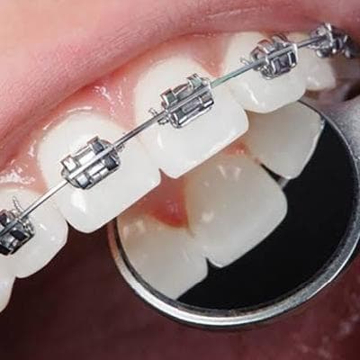 مهمترین عوارض ارتودنسی و علل بروز آن