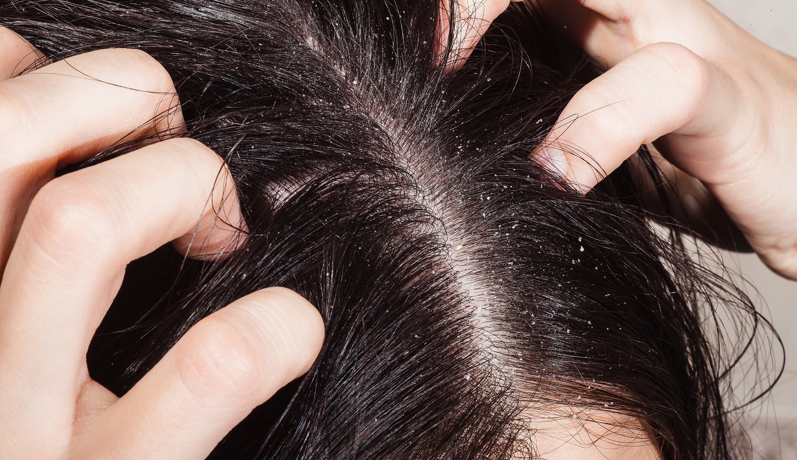 علت چرب شدن مو چیست؟