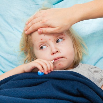 بیماری سرخک در کودکان و زمان واکسن زدن