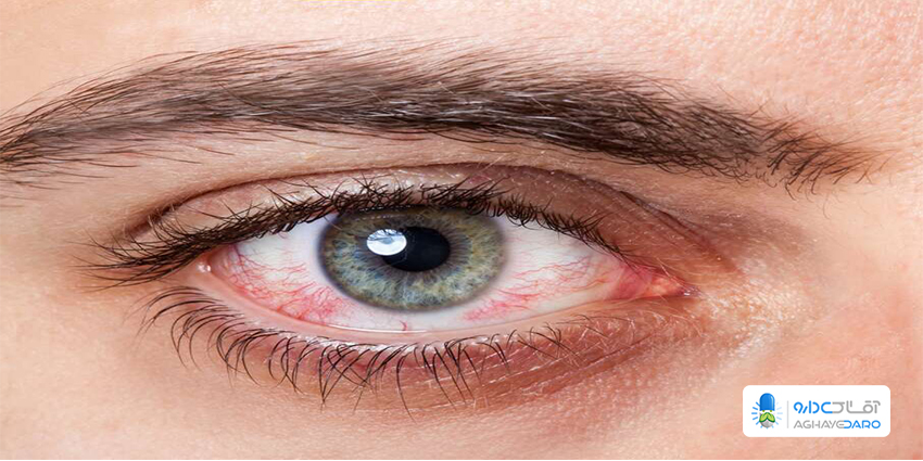 خشکی چشم و علل آن