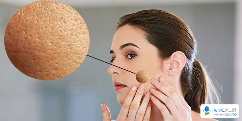 بهترین روش برای درمان منافذ باز پوستی