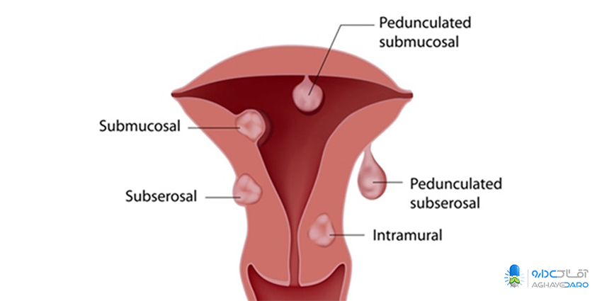 نشانه‌ها و علائم عفونت واژن