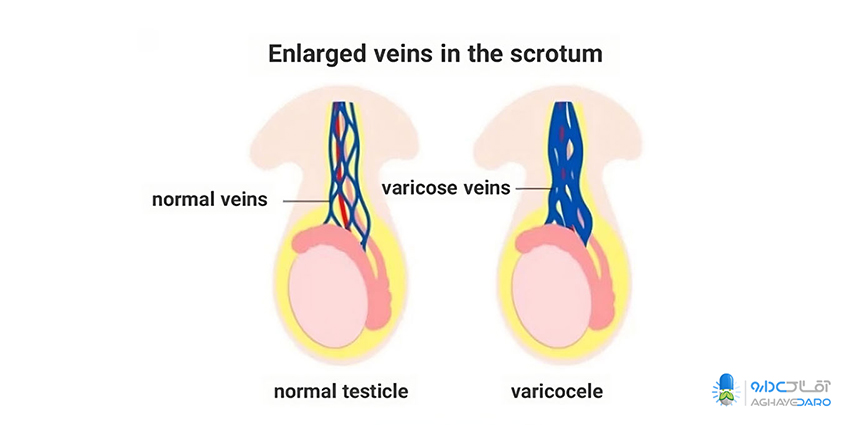 راهکار‌های درمان واریکوسل