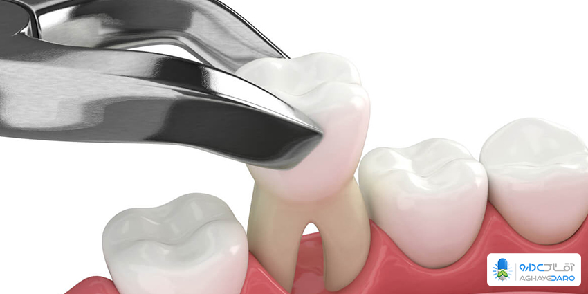 آشنایی با انواع دندان عقل 
