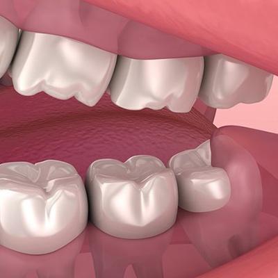 هرآنچه لازم است درباره دندان عقل بدانید