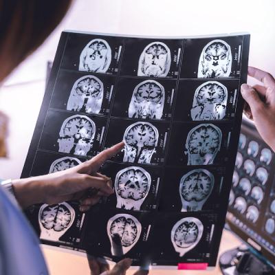 فشار خون بالا و سلامت مغز؛ قاتل حافظه شما