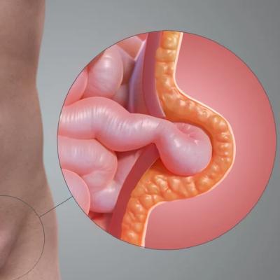 آیا فتق بیضه خطرناک است؟ همه چیز درباره عمل فتق بیضه