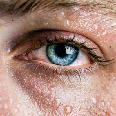 علت عرق زیاد سر و صورت چیست؟ راهکارهای کنترل و درمان قطعی