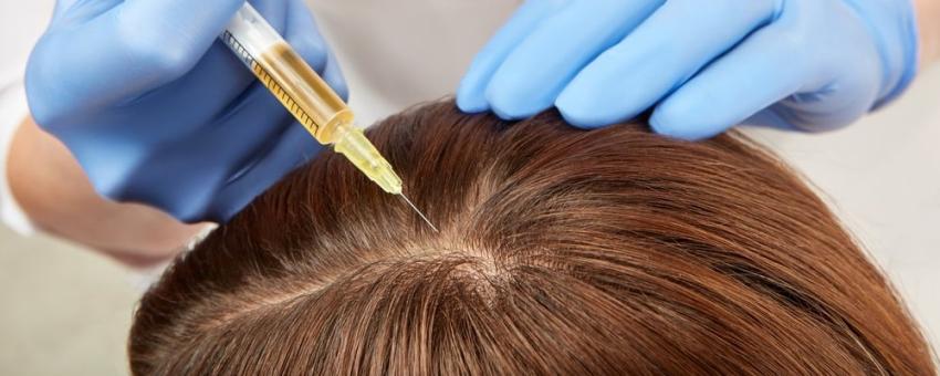 پی آر پی مو | روش درمان ریزش مو با پلاسمای غنی از پلاکت