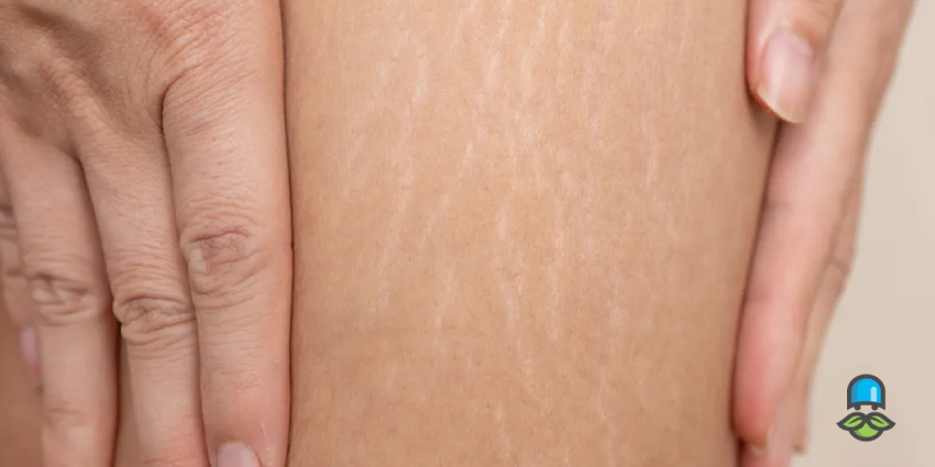 روش‌های پیشگیری از ترک‌های پوستی