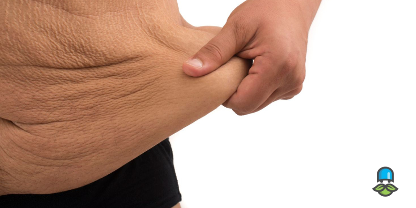 چرا پوست بعد از کاهش وزن آویزان می‌شود؟