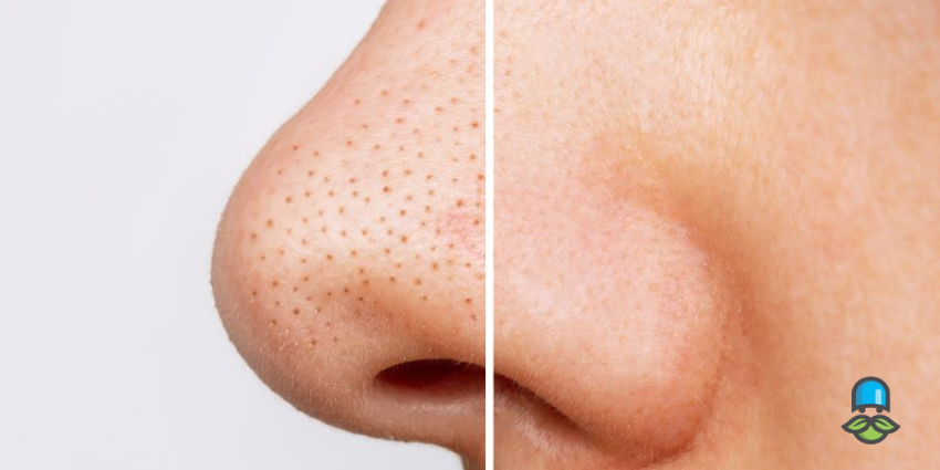 با دانه‌های سیاه روی بینی چه کنیم؟