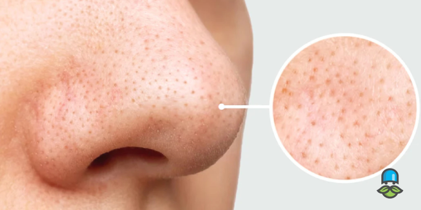 چرا نباید دانه‌های روی بینی را فشار دهیم؟