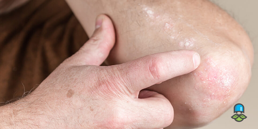 کتوکونازول و فلوکونازول را چگونه مصرف کنیم؟