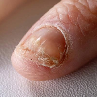 صفر تا صد علت جدا شدن ناخن از گوشت