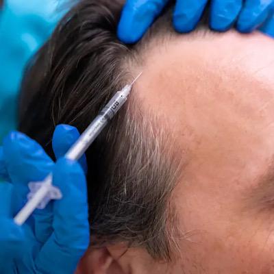 همه چیز درباره اگزوزوم تراپی مو؛ از نتایج واقعی تا مقایسه با PRP