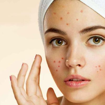 نیاسینامید چیست و چه تاثیری بر منافذ باز و جوش دارد؟