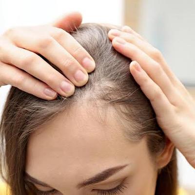 راه های پیشگیری از ریزش موهای چرب