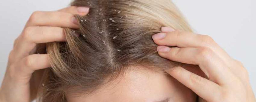 راه های پیشگیری از ریزش موهای چرب