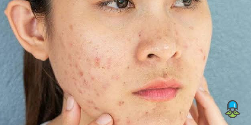 آیا جوش صورت می‌تواند نشانه بیماری خاص باشد؟