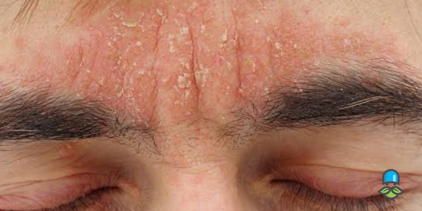  درماتیت سبورئیک یا درماتیت سبوره چیست؟