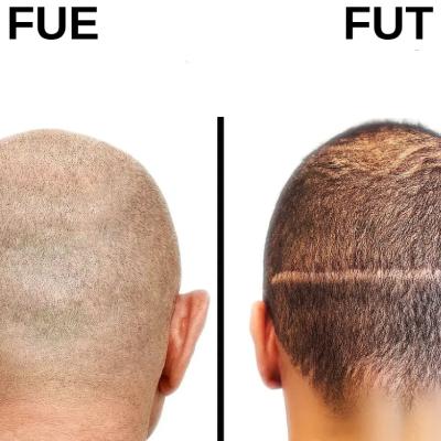 تفاوت بین روش‌های FUE و FUT در کاشت مو؛ کدام روش برای شما مناسب‌تر است؟