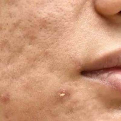 جوش صورت نشانه چیست؟ + مهم‌ترین نکات
