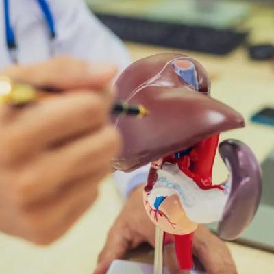 کبد چرب گرید 3؛ همه نکات درباره علائم و درمان
