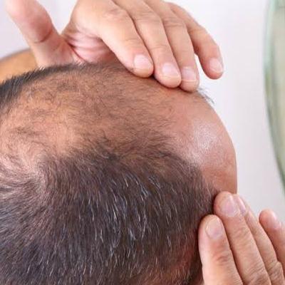 ریزش موی سکه ای و موثرترین راهکارهای درمانی