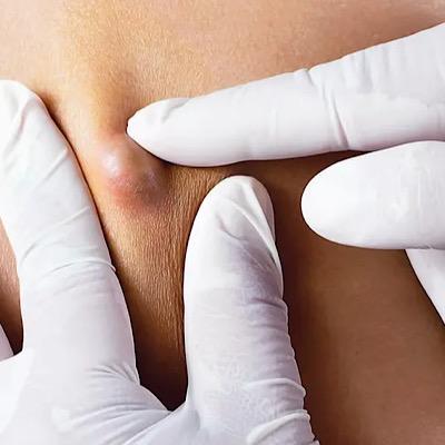 مهم‌ترین علائم کیست مویی و درمان این بیماری شایع
