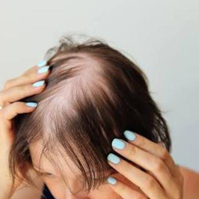 مهم‌ترین تاثیر کبد چرب بر ریزش مو