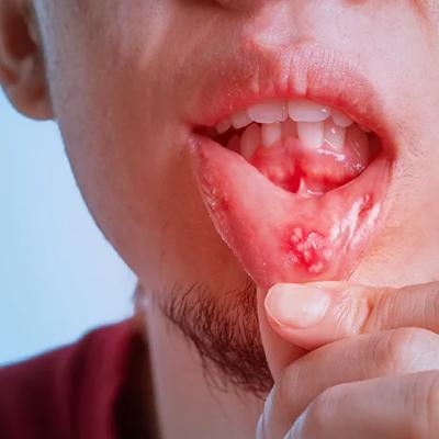همه آنچه باید درباره سرطان دهان بدانید: نشانه‌ها، علل و روش‌های درمان